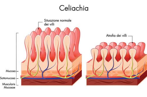 celiachia-spiegazione.jpg